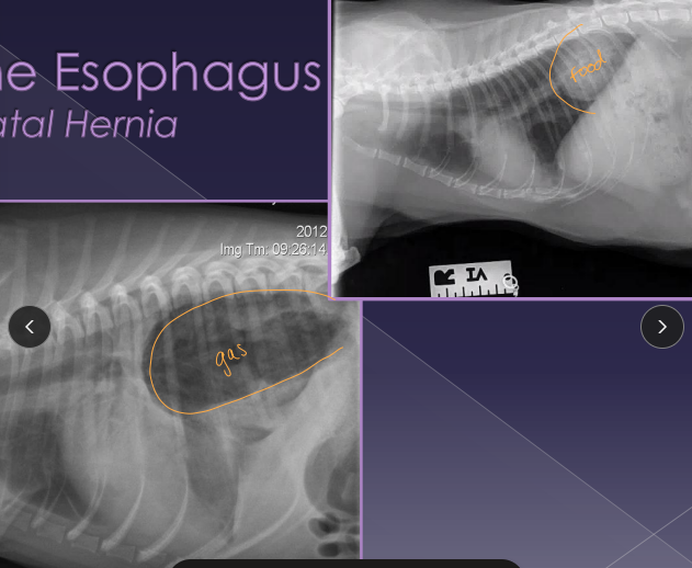 <p><span>Hiatal Hernia</span></p>