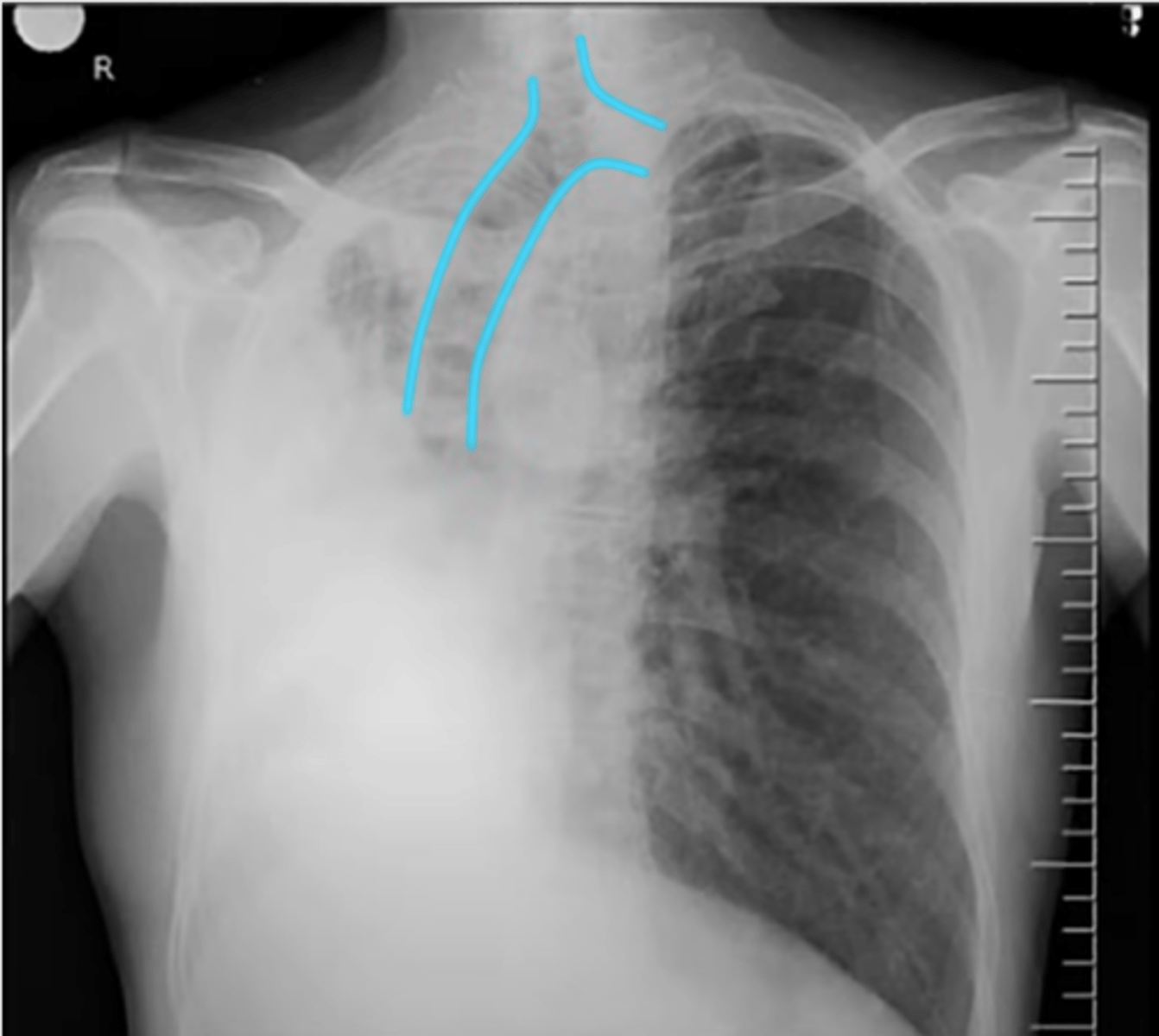 <p>-towards one side</p><p>-atelectasis associated with collapse of part or an entire lung</p>