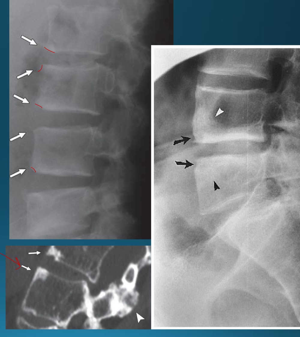<p>what are the signs seen in this image? what diagnosis would you make? </p>