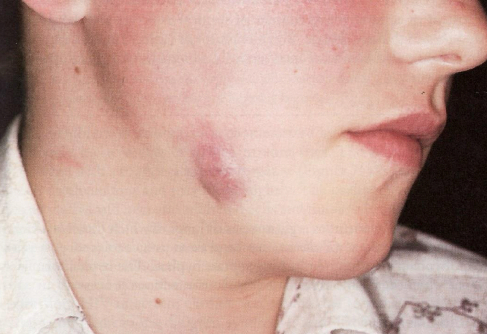 <p>Abscess&nbsp;</p>