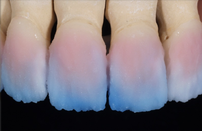 <p>uses a layered technique → get higher esthetics → more time consuming </p>