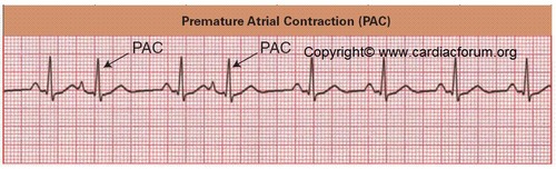 irregular heart rhythm characterized by atrial contractions occurring before the expected time