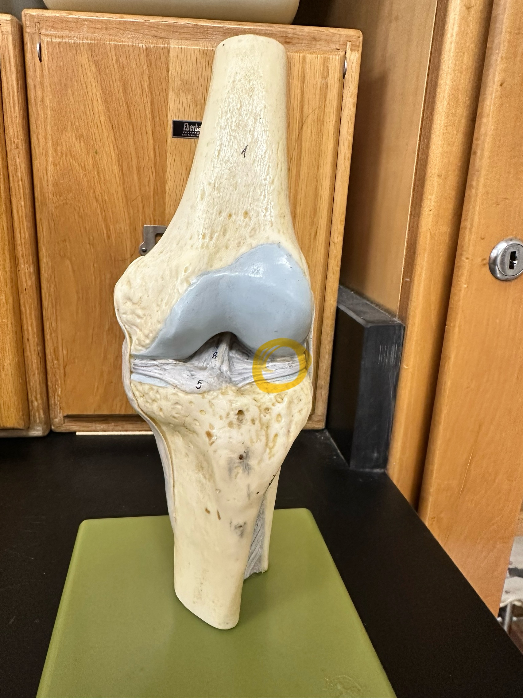 <p>Tibial (medial) collateral ligament</p>