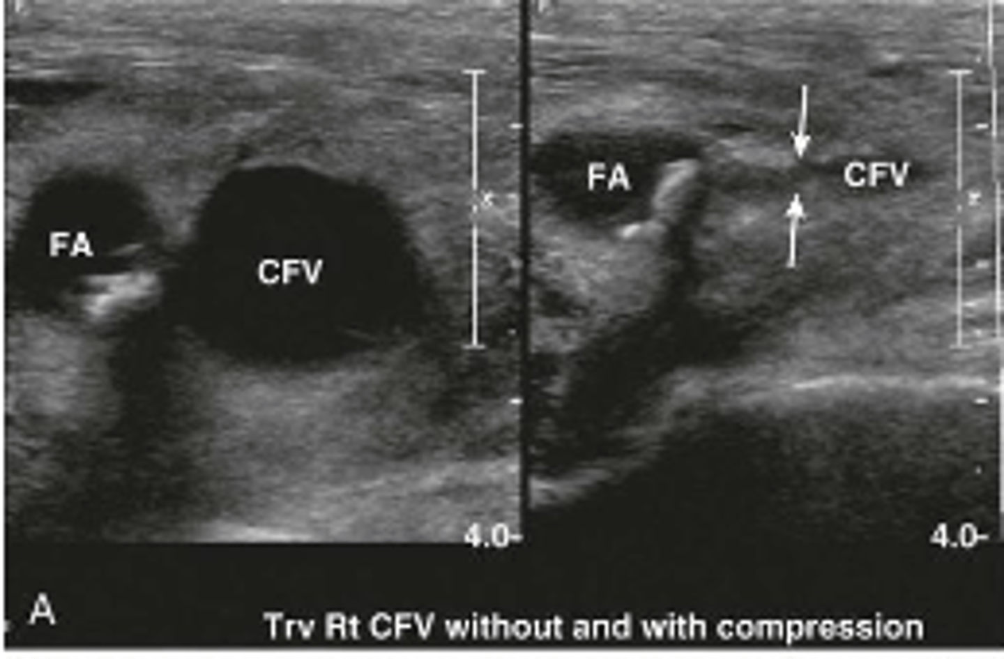 <p>On this ultrasound, you are applying pressure to compress this vein. What is the diagnosis?</p>