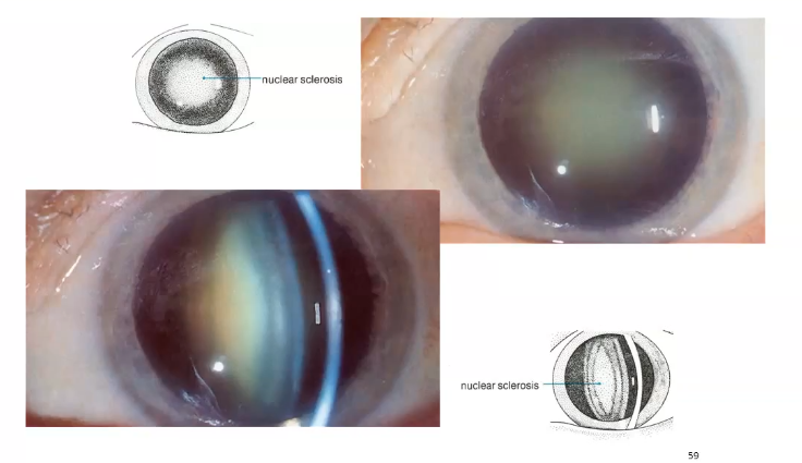 <p>nucleus has opacified</p><p>an opacity located in the embryonic, fetal or adult nucleus is called nuclear cataract </p>