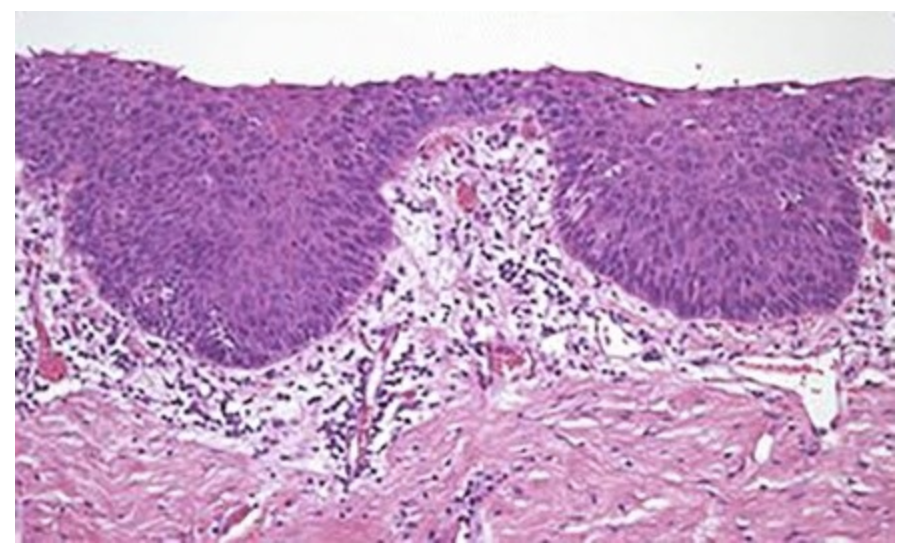 <p>A 62-year-old man visited the dental clinic for restorative consultation regarding his failing maxillary dentition. The patient had not seen the dentist in many years. During his comprehensive oral examination, the periodontist discovered an asymptomatic red, macular lesion on the left posterior hard palate, 1.5 × 1.5-centimeter in diameter. The patient was not wearing a denture, and no other obvious source of irritation could be identified. A 30-year history of smoking was elicited. An incisional biopsy of the palatal lesion was performed, and the microscopic appearance is shown in the attached figure. What is the most likely diagnosis?&nbsp;</p><p>&nbsp;</p><p>Erythroplakia</p><p>&nbsp;</p><p>Squamous cell carcinoma</p><p>&nbsp;</p><p>Verrucous carcinoma</p><p>&nbsp;</p><p>Aphthous stomatitis</p><p>&nbsp;</p><p>Pyogenic granuloma</p>