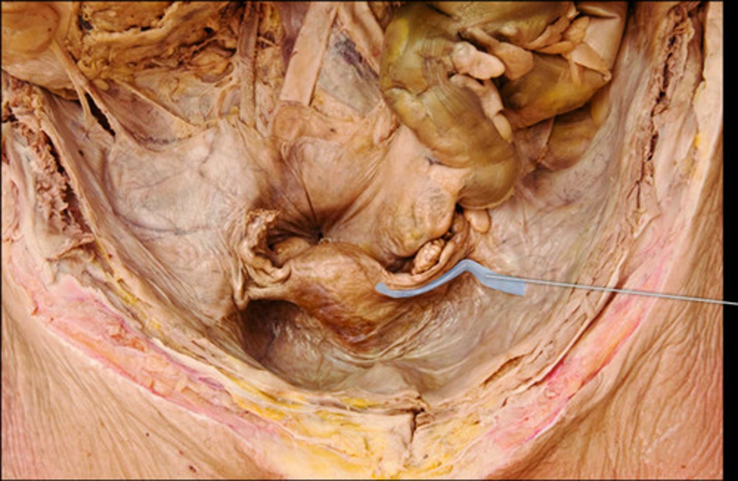 <p>round ligament</p>