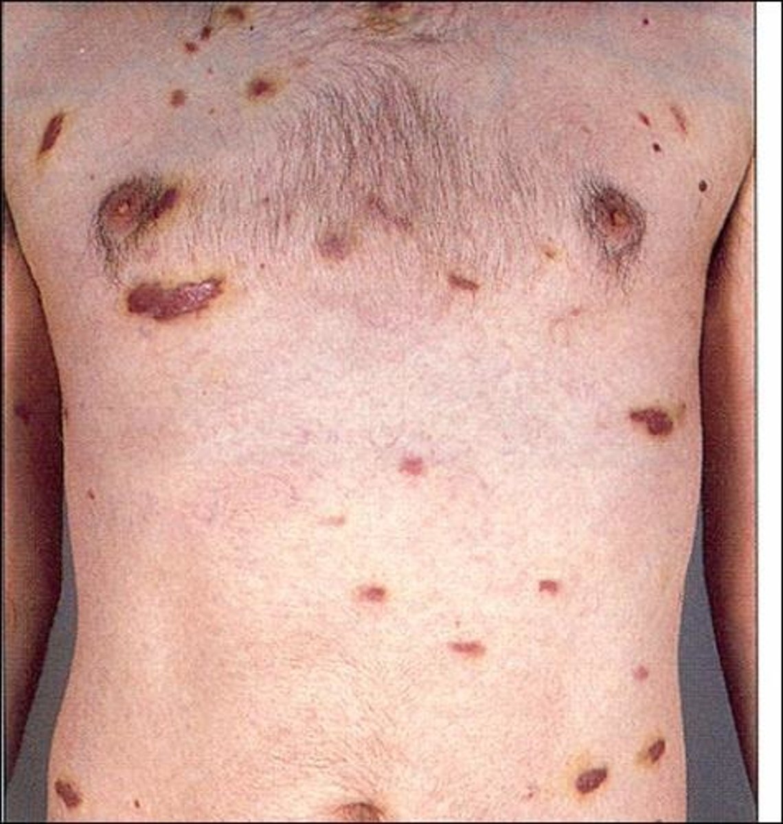 <p>a cancer that causes patches of abnormal tissue to grow under the skin, in the lining of the mouth, nose, and throat, or in other organs; frequently associated with HIV</p>