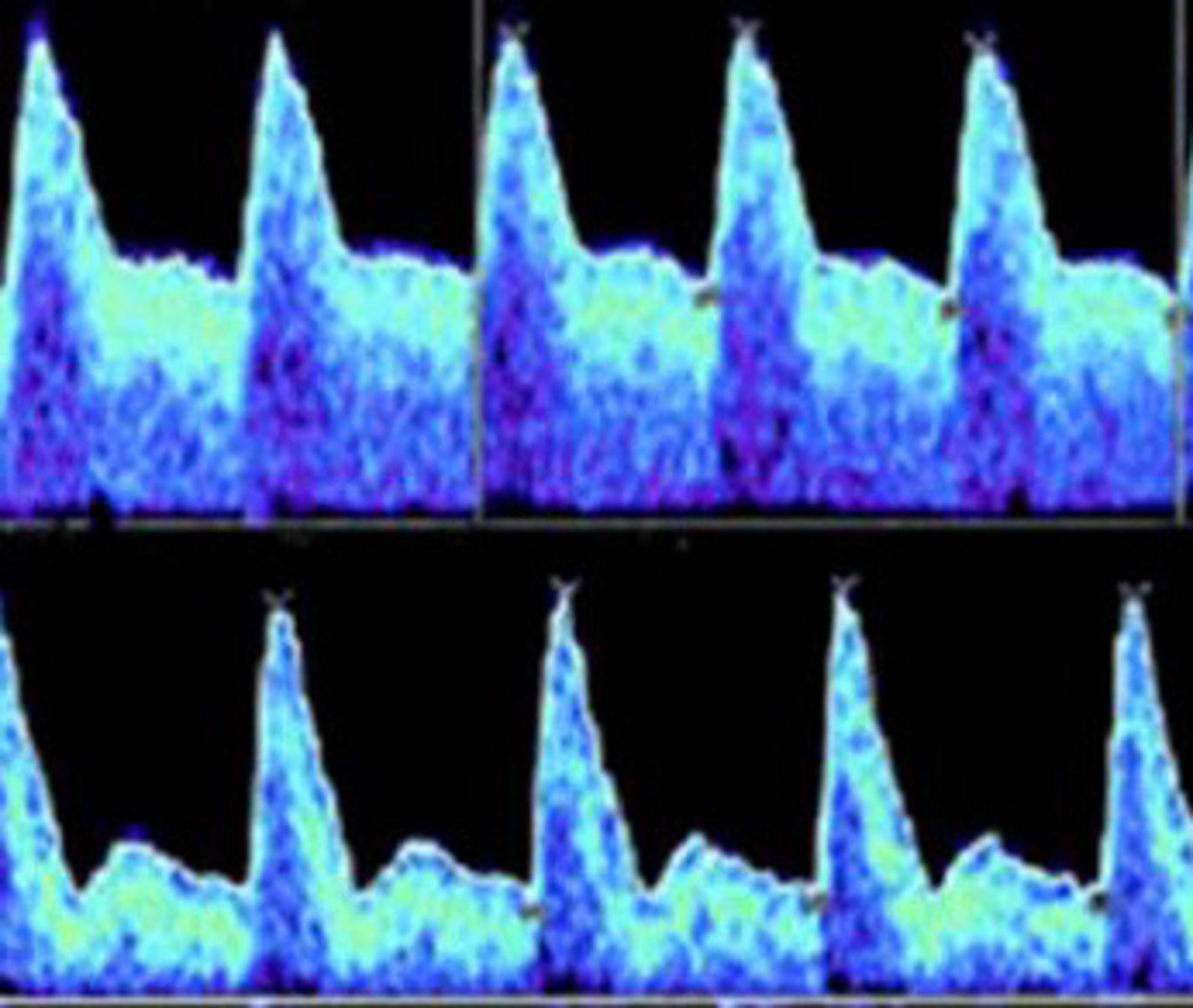 <p>Is the spectral of the uterine artery on the top normal or abnormal</p>
