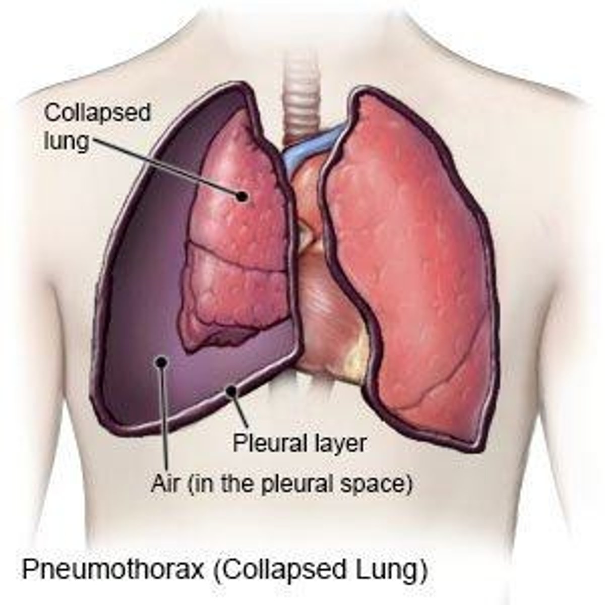 <p>-collapsed lung</p><p>-air enters the pleural space which pushes on the lung and then causes it to collapse</p>