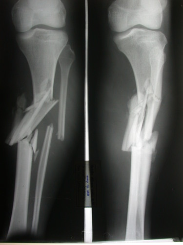 <p>Open fracture</p>