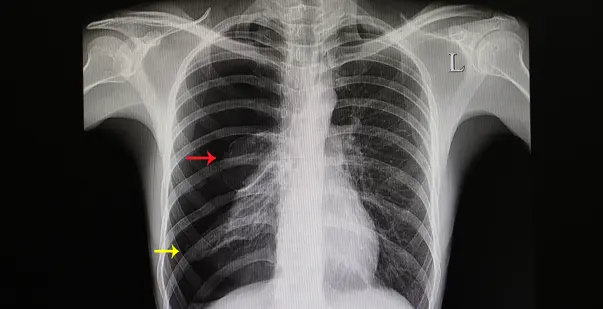 <p>What is pneumothorax?</p>