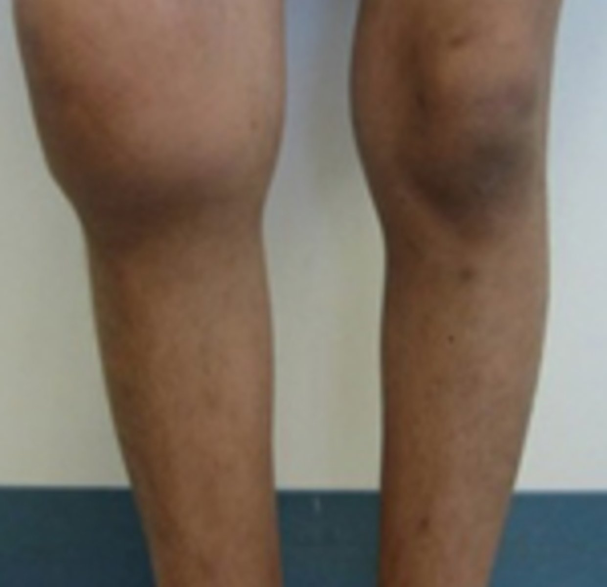 <p>Recurrent bleeding into joint spaces (the classic symptom of hemophilia)</p>