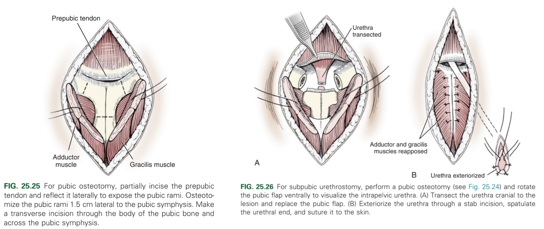 <p>Ventral midline incision from umbilicus to pubis → Partially incise <strong>prepubic tendon</strong> and reflect it laterally to expose <strong>pubic rami</strong> → (pubic osteotomy) osteotomise pubic rami 1.5 cm laterally to pubic symphysis and transverse incision through body of pubic bone → rotate pubic flap ventrally to visualise intrapelvic urethra → transect urethra cranial to lesion/obstruction and replace pubic flap → urethra exteriorised caudal to the brim of the pubis through stab incision → spatulate urethral end and suture to skin.</p>