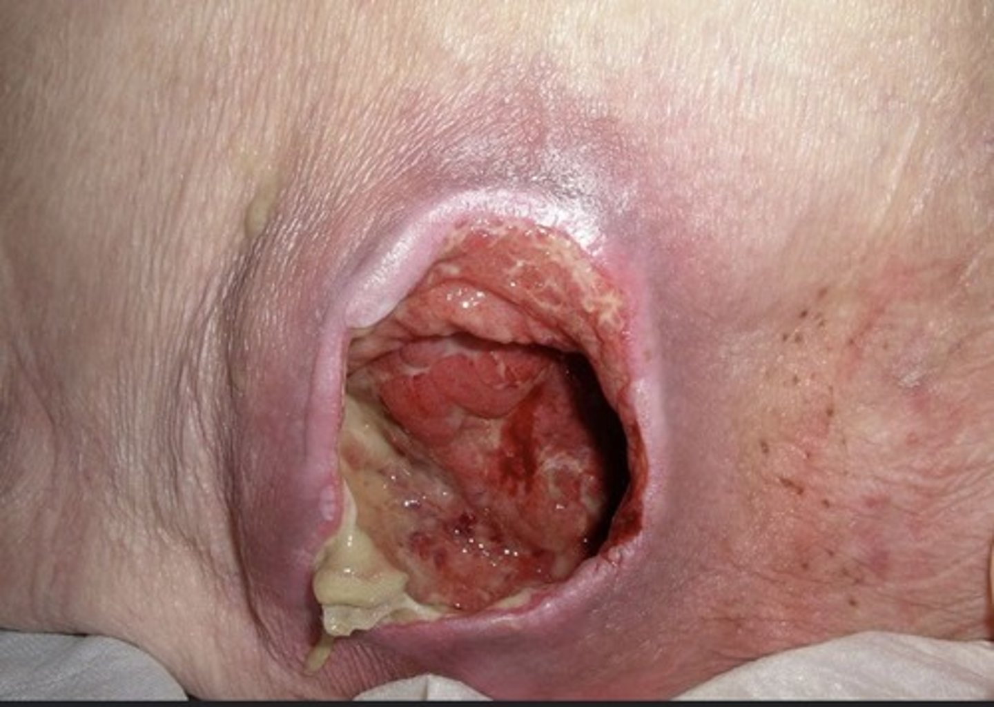 <p>i) Full-thickness skin and tissue loss</p><p>ii) Muscle, tendons, ligaments, cartilage, or bone involvement</p><p>iii) Slough and eschar</p><p>iv) Undermining and tunneling often</p>