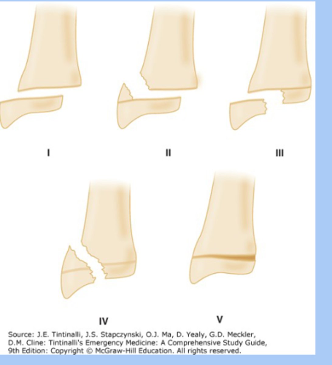 <p>-fracture involving epiphyseal plate </p><p>-type 1: physis fracture </p><p>-type 2: metaphysis and physis </p><p>-type 3: epiphysis and physis </p><p>-type 4: epiphysis and metaphysis </p><p>-type 5: crush fracture </p><p>-dx: XRay </p><p>-tx: splinting, immobilization, surgery </p><p>-permanent growth arrest </p>