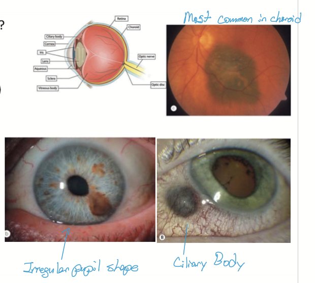 <ul><li><p>choroid: often asymptomatic </p></li><li><p>iris</p></li><li><p>ciliary body </p></li></ul><p></p>