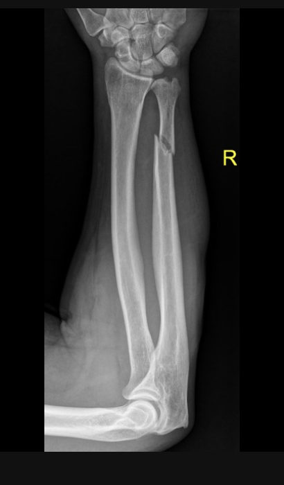 <p>Ulnar shaft fracture usually at the distal 1/3 junction due to a direct blow when trying to block/shield</p>