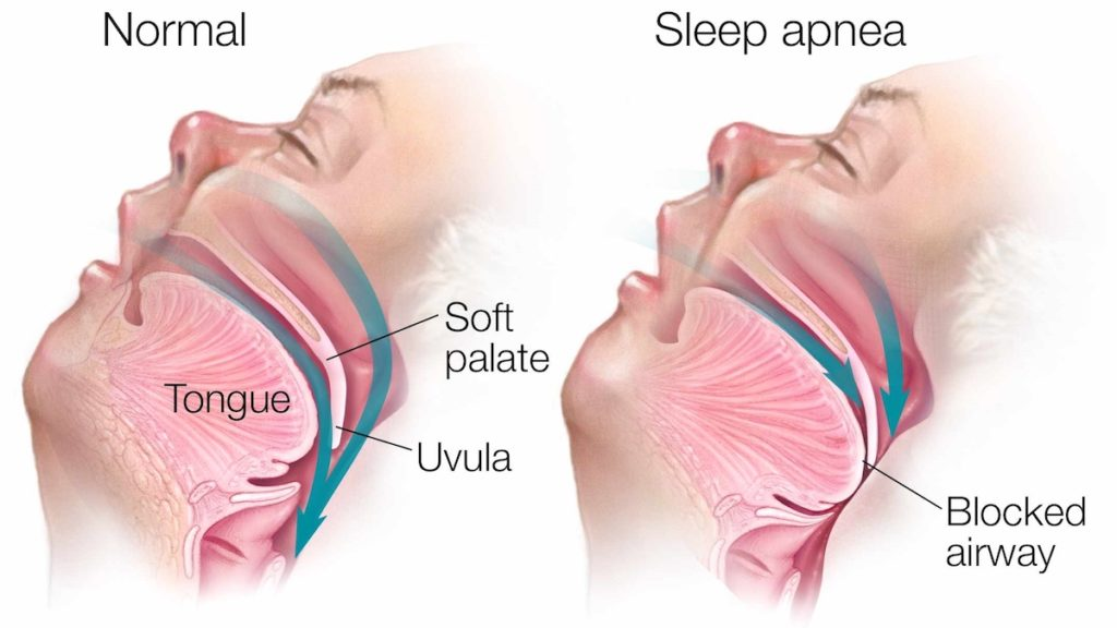 <p>The relaxation of the muscles at the back of your throat to the point where it denies proper breathing.</p>