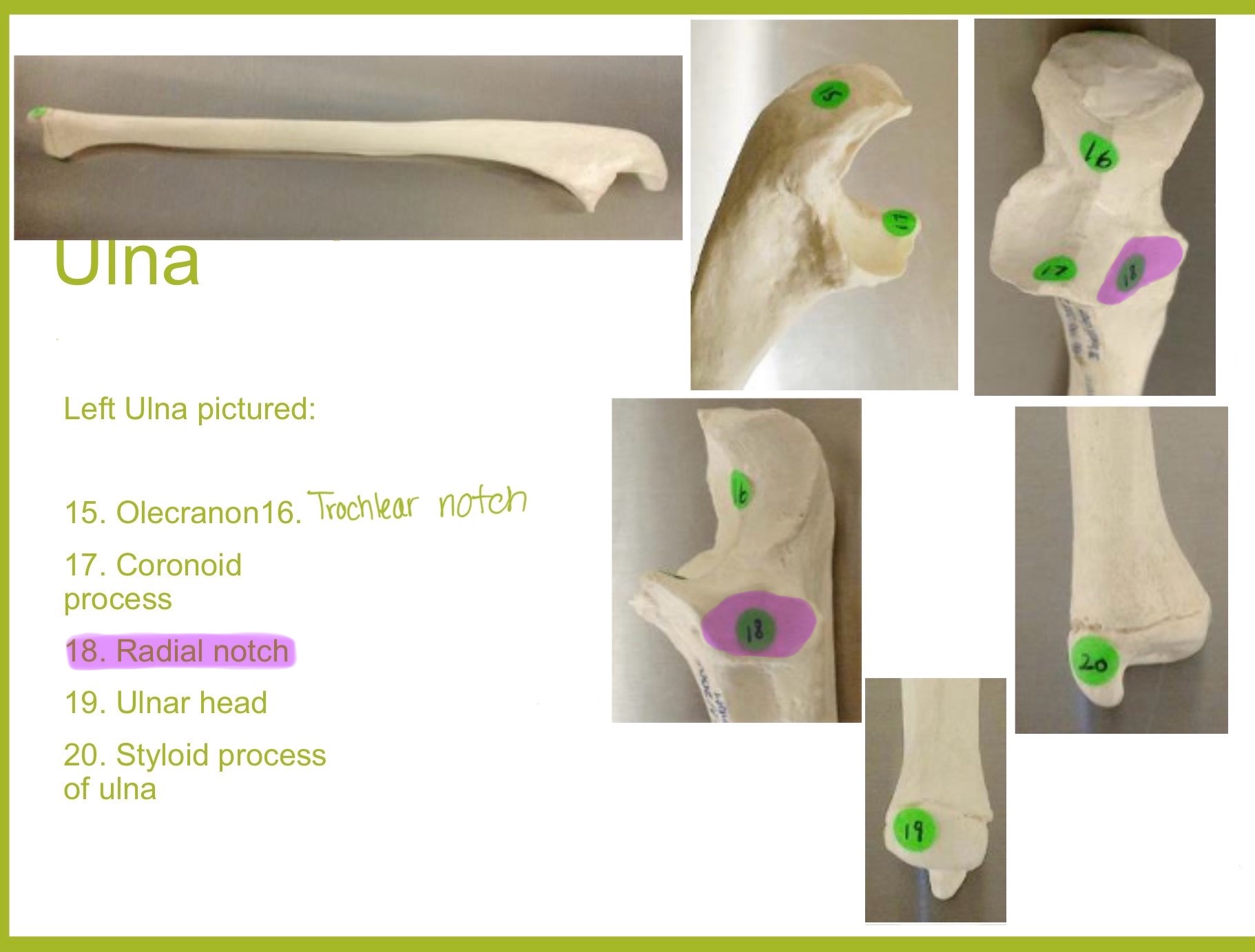 <p>radial notch of ulna</p>