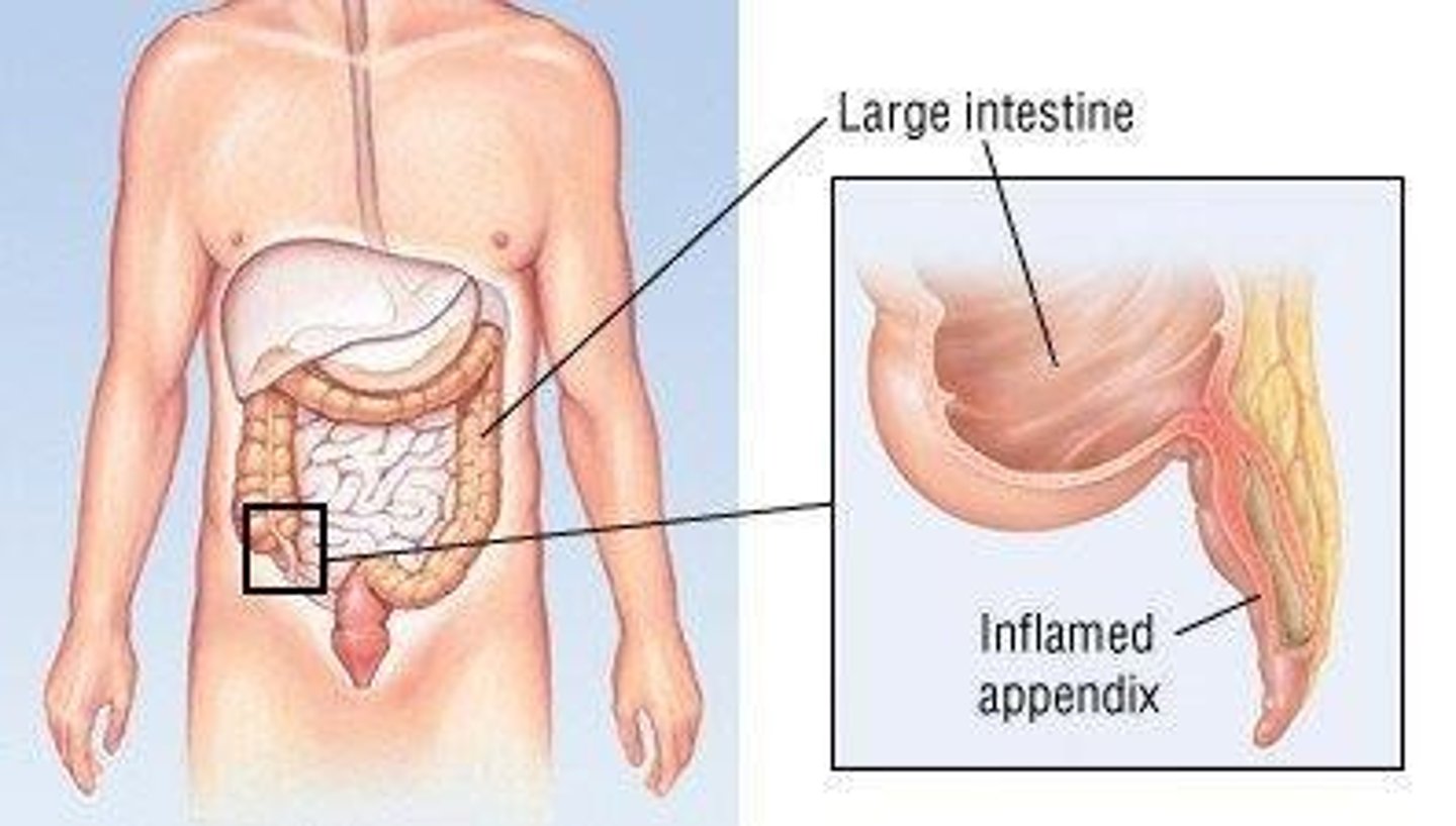 <p>Inflammation of the appendix causing pain.</p>