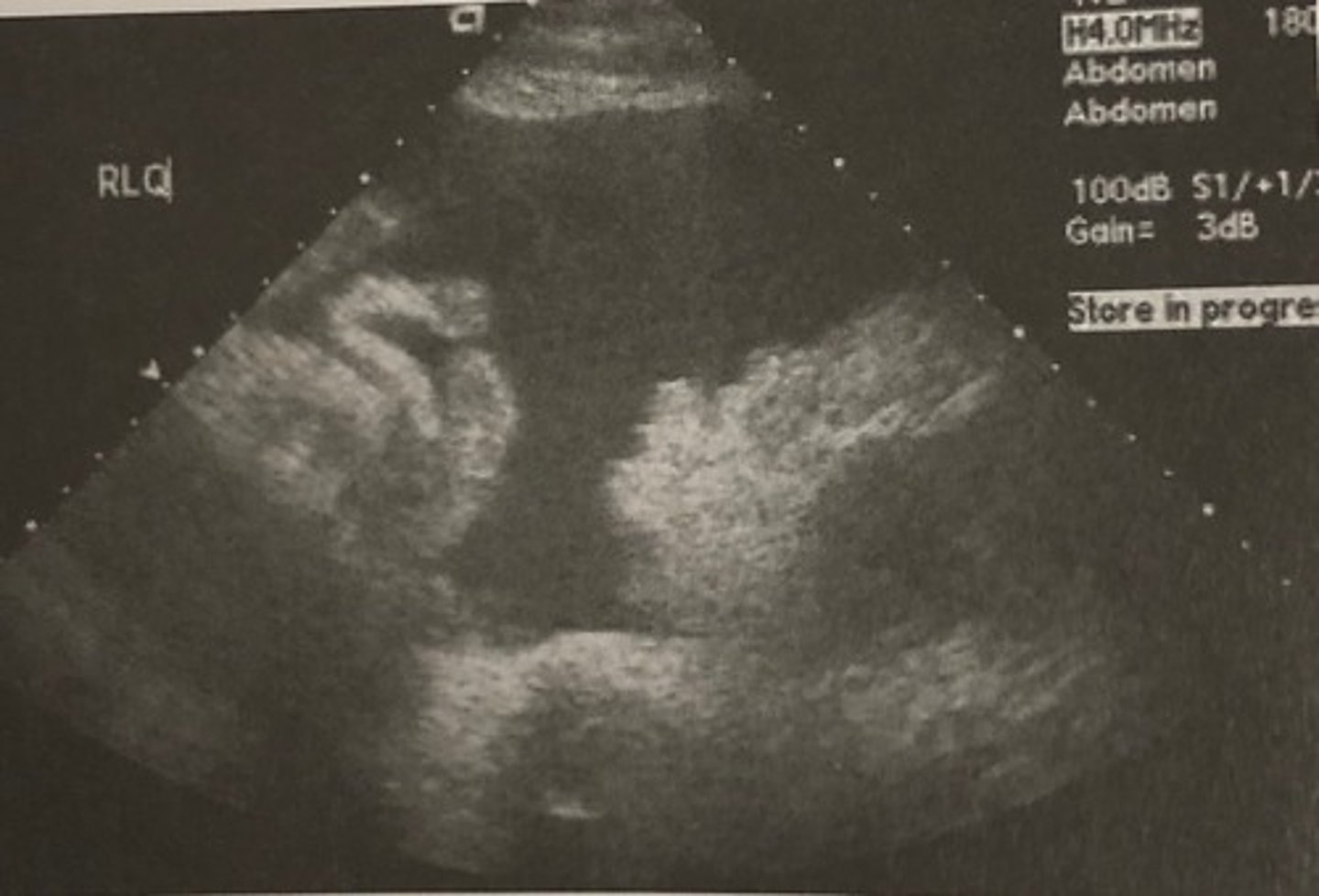 <p>637. This longitudinal sonogram through the right lower quadrant of the patient described in question 636 suggests:</p><p>A. Ruptured appendix</p><p>B. Endometriosis</p><p>C. Pelvic ascites</p><p>D. Ruptured ectopic pregnancy</p><p>E. Pelvic inflammatory disease</p>