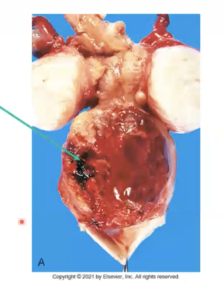 <ul><li><p>Arise from soft tissue (CT - components of mesoderm)</p><ul><li><p>Examples: nerves, muscle, fat, bone, cartilage, fibroblasts, blood vessels</p></li></ul></li></ul><ul><li><p><strong>Generally big and&nbsp;“fleshy fish”, soft → no desmoplasia</strong></p></li></ul><p></p>