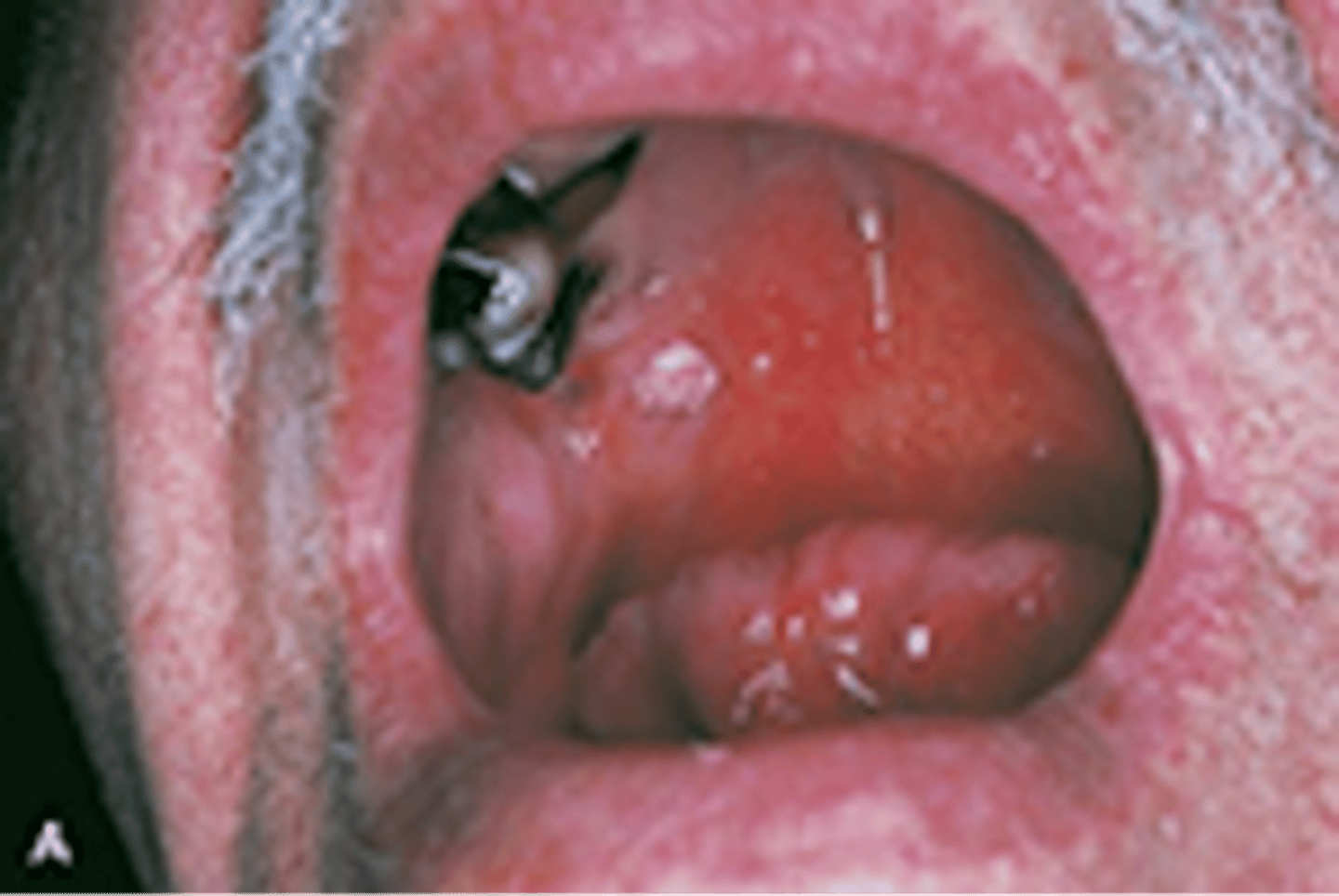 <p>a benign, superficial wart-like growth on the epithelial tissue or elsewhere in the body, such as in the bladder</p>