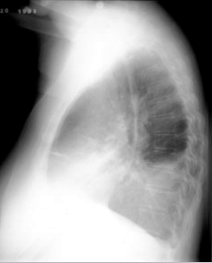 <p>upright shows costophrenic angle blunting, lateral decubitus shows fluid along the lateral chest wall</p>