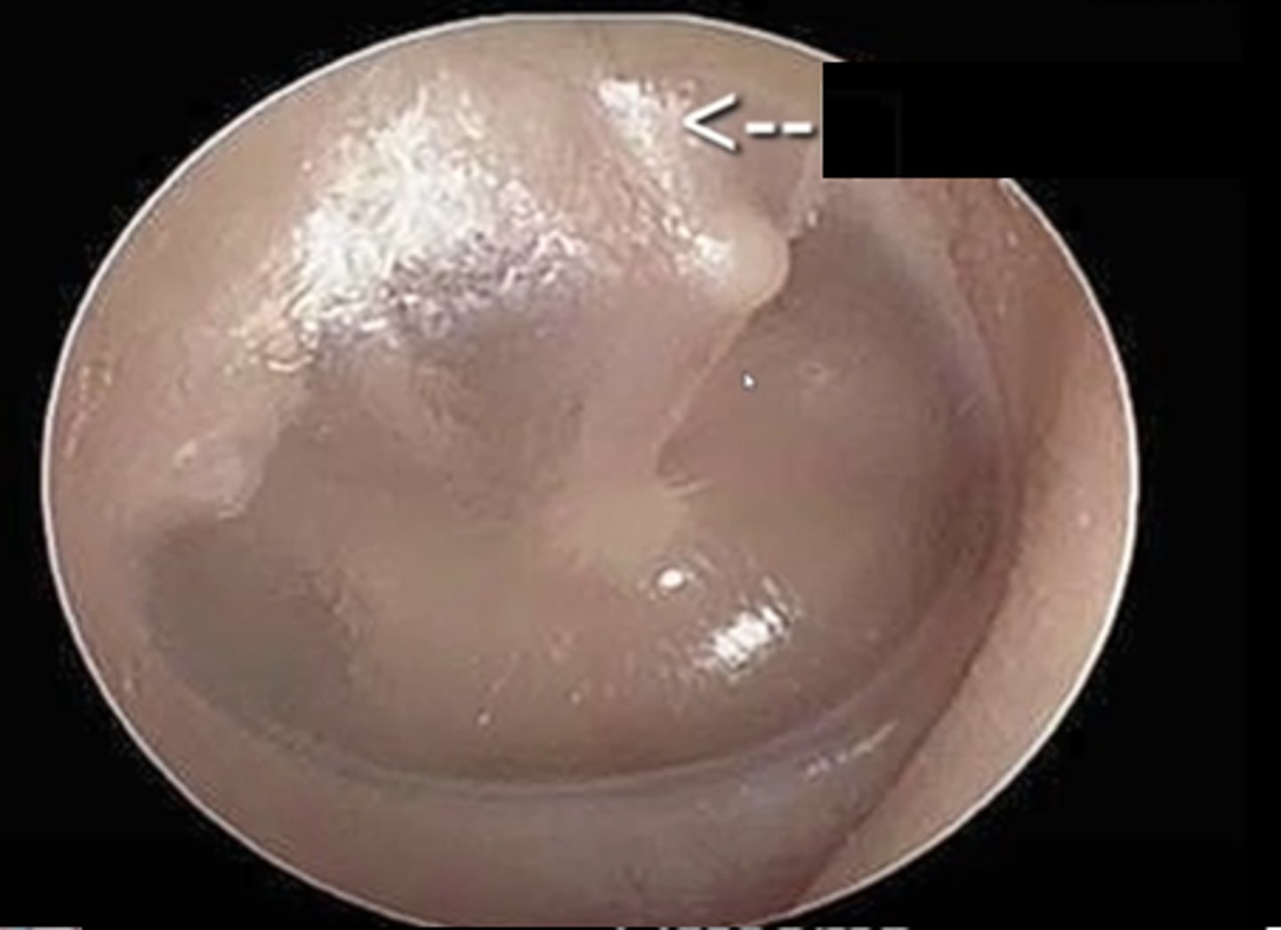 <p>What is wrong with this tympanic membrane?</p>