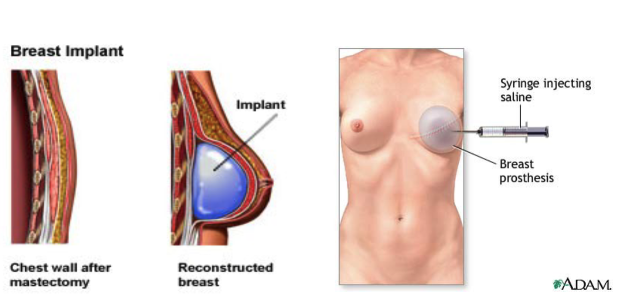 <p>a <strong>temporary device</strong> placed under the skin and gradually filled with saline to stretch the tissue before placing a permanent implant.</p>