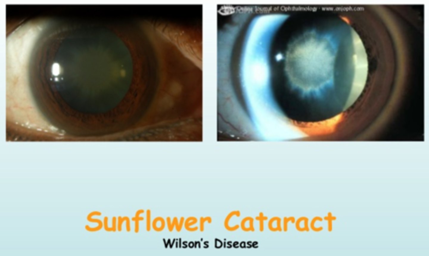 <p>copper deposits affecting the lens</p>