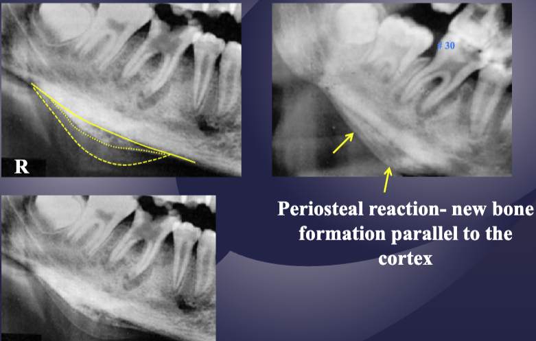 <ol><li><p>bone formation aka periosteal stimulation aka “onion skin” pattern</p></li><li><p>bone resorption</p></li><li><p>fistula</p></li><li><p>pathologic fracture&nbsp;</p></li></ol><p></p>