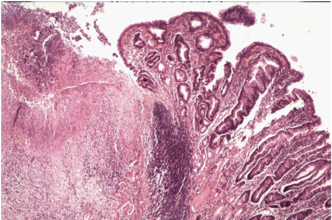 <p><strong><span>Describe what you can see in the histological images- </span>where in the lesion does this tissue section come from?</strong></p>