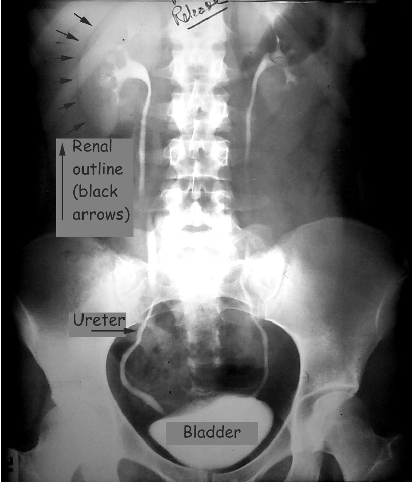 <p>intravenous pyelogram; iodine based contrast material injected IV and rapidly cleared by kidneys (contrast slightly enlarges kidneys)</p><p>xray exam that uses injection of contrast material to evaluate kidneys, ureters, and bladder</p>