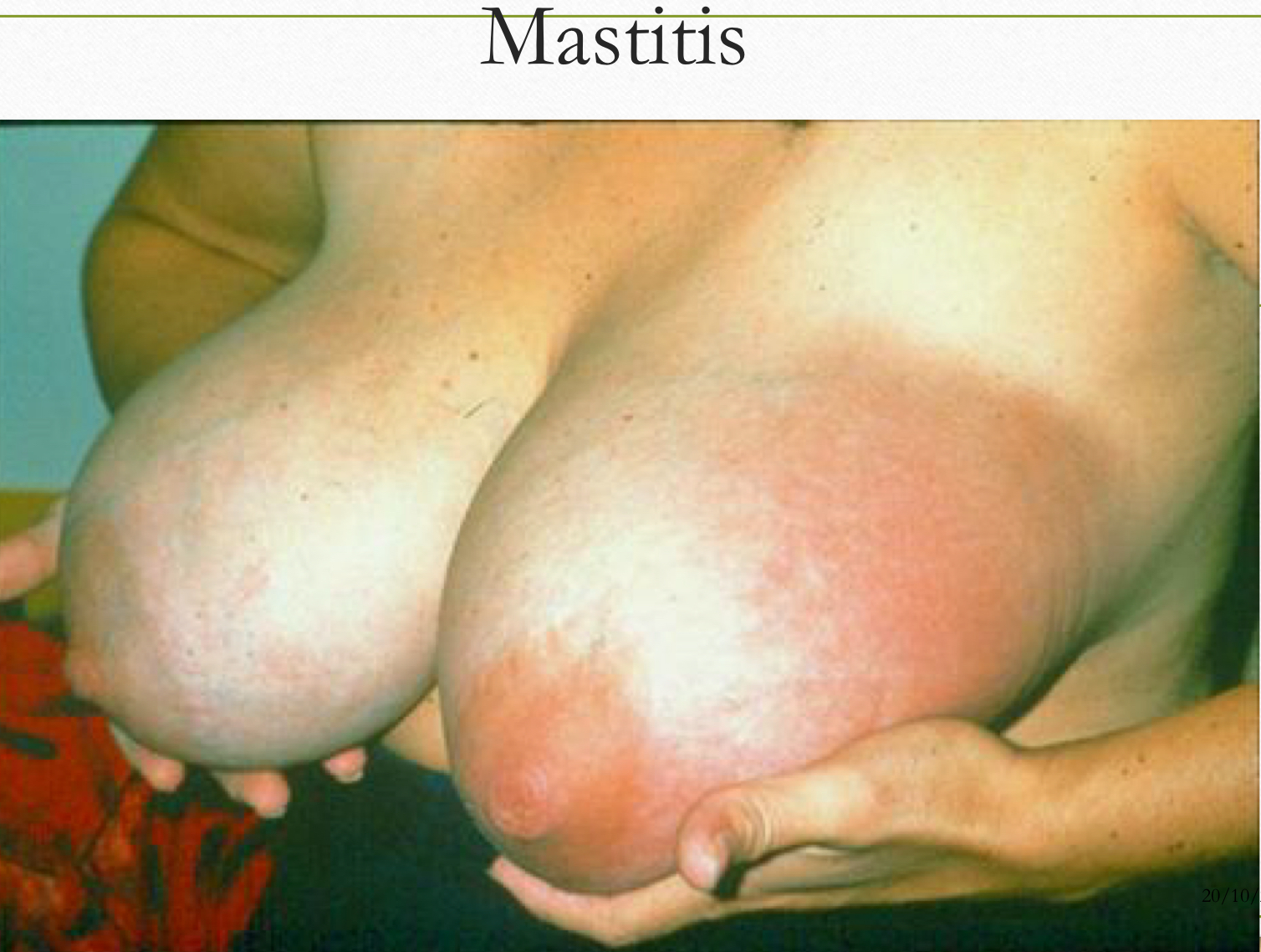 <p>Briefly explain blocked duct and mastitis in term of</p><ul><li><p>what is it </p></li><li><p>causes</p></li><li><p>clinical presentation</p></li><li><p>management </p></li></ul><p></p>