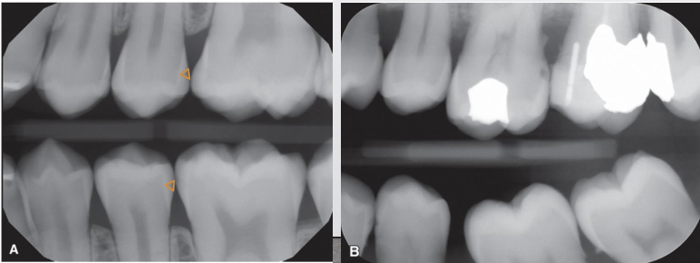 <p>What are incipient caries?</p>