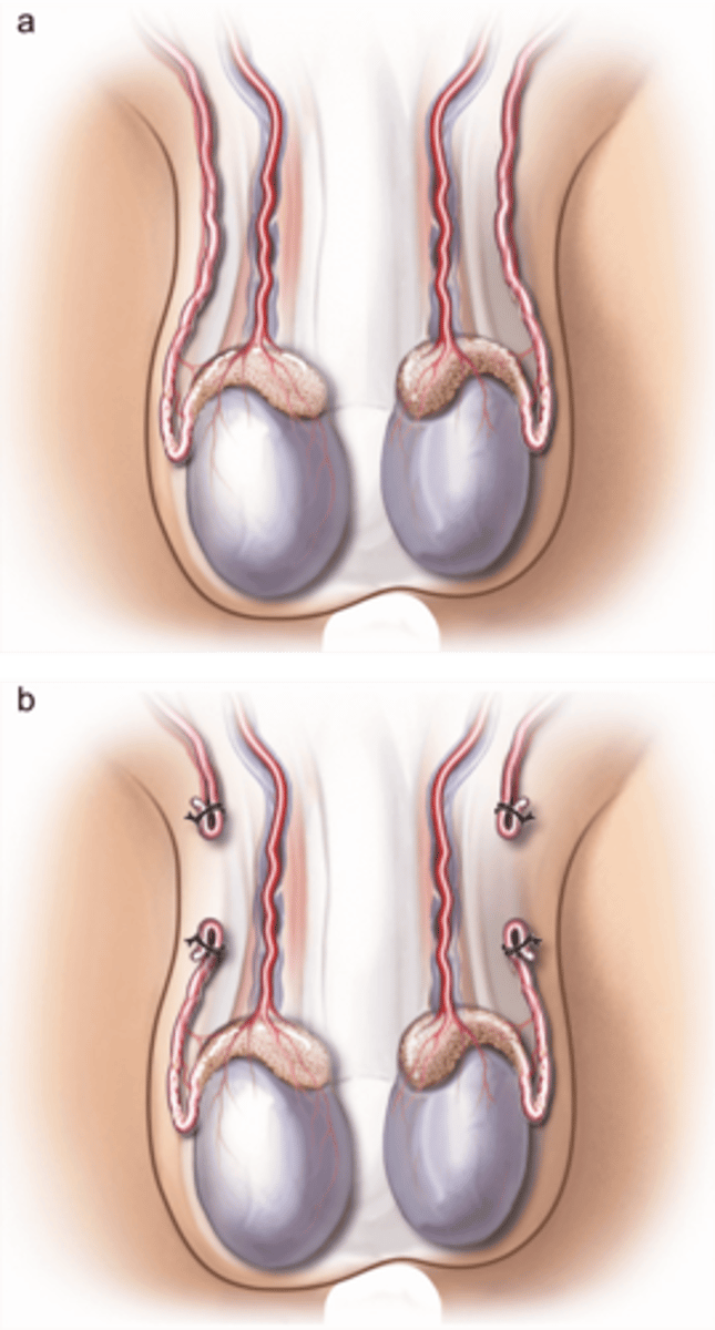 <p>Chapter: Sexual Offences (Common Element 2: Absence of Consent - s76: Conclusive Presumptions about Consent)</p><p>Facts: A lied to B about having had a vasectomy with the consequence that B agreed to have unprotected sex when otherwise she would have insisted on using a condom. B got pregnant later</p><p>Principle:</p><p>- B not deceived as to the sexual intercourse, only the broad circumstance around it. Unlike R (F) or Assange which are directly related to intercourse, the courts find that deception as to the nature of the circumstances surrounding the act are not liable. In Assange and F, the complainants had not consented to the presence of a physical substance within their body, whereas Lawrance concerned the possible consequences of the relevant physical substance being inside V’s vagina (prosecution claimed that all 3 cases involved women who sought to avoid pregnancy). Distinguishes cases like R v B where the non-disclosure of D’s HIV cannot vitiate consent in sexual intercourse as it is not material to the sexual act itself but the consequences, whereas in Lawrance, D made a positive representation about his infertility (controversial decision). Judge ruled that R v B was distinguishable because the subject matter was the risk of disease rather than pregnancy</p><p>- The case also provided further hypothetical examples that would not satisfy the “close connection” test like lies concerning marital/relationship status, lies about political or religious views, and lies about status, employment or wealth. Also confirmed Linekar that a prostitute consents validly even if the client never intends to pay.</p>