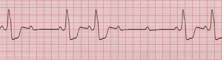 <p>then you have a mobitz 2</p><p>Pr are constant </p><p>(second degree heart block type 2)</p>