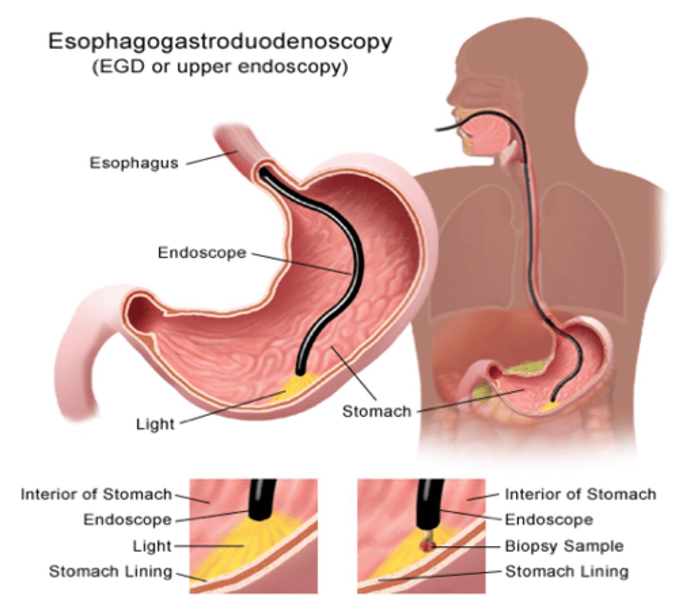 <p><strong><span style="text-decoration:underline">EGD</span></strong> (Esophago<strong>Gastro</strong>Duodenoscopy)</p>