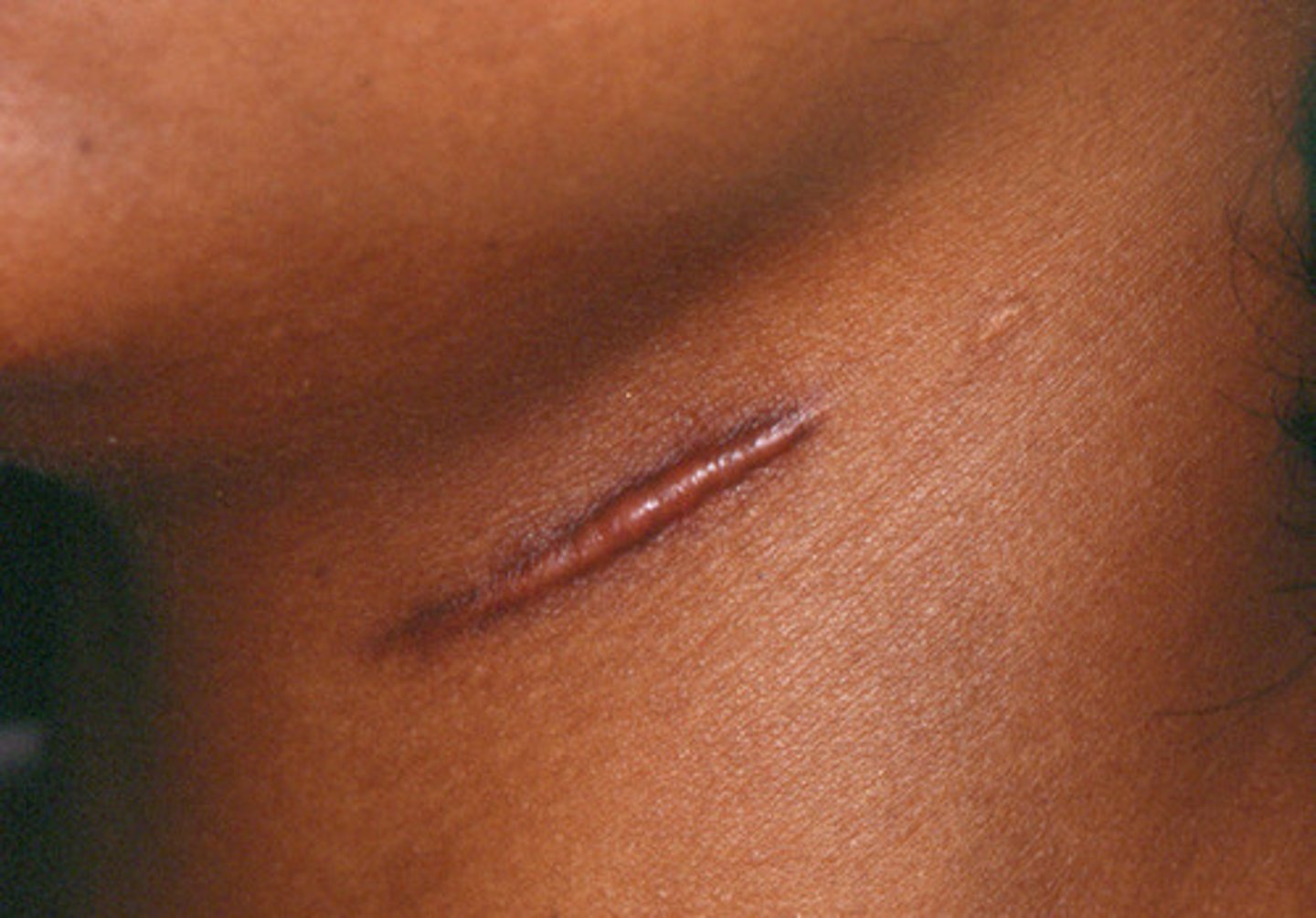 <p>= roodheid en zwelling op litteken. Dit kan gepaard gaan met jeuk of pijn. Kan ook vanzelf herstellen.</p>
