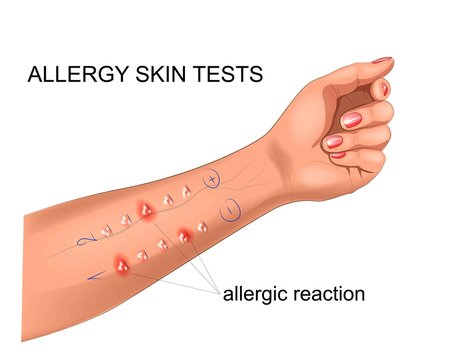 <p>A test introduce allergens into a scratched area on the patient’s skin with a special tool or needle</p><p>Positive reactions: redness, itching, swelling</p>