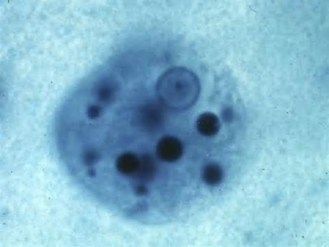 <p>in human stool</p><p>diarrhea, fatigue, straining pain</p><p>worldwide</p>