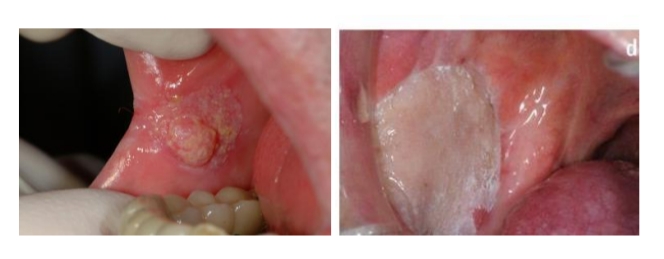 <p>Trismus<br>Mobiliteit en innervatie orale musculatuur</p>