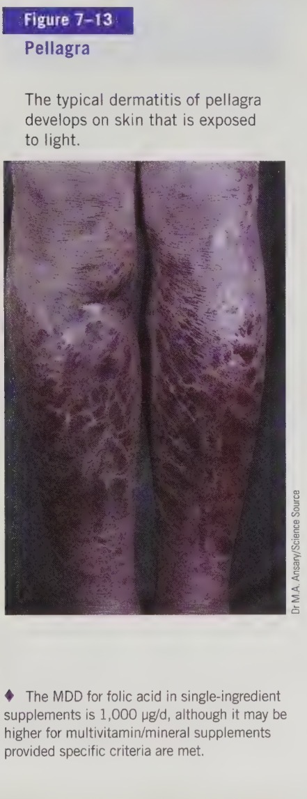 <ul><li><p>called pellagra</p></li><li><p>symptoms include 4 D’s: diarrhea, dermatitis, dementia, and ultimately death</p></li><li><p>also see headaches, abdominal pain, vomiting, and the tongue can become smooth, swollen and red or black in colour</p></li><li><p>Pellagra appeared in Europe in the 1700’s when corn became a staple food (corn protein is limited in tryptophan). It is still common in parts of Africa and Asia.</p></li></ul><p></p>