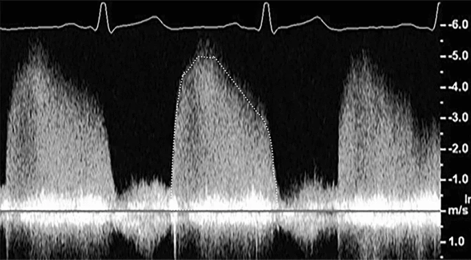 <p>Describe this trace in terms of:</p><ul><li><p>modality</p></li><li><p>quality of flow</p></li><li><p>peak velocity</p></li><li><p>shape of the flow</p></li><li><p>what is being measured</p></li></ul><p></p>