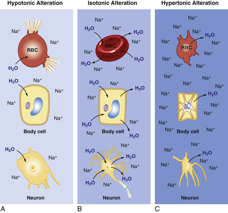 <ul><li><p>Isotonic alteration: fluid is shifting equally/everywhere → equal sodium everywhere </p></li><li><p>Hypotonic alteration: low sodium in bloodstream and increased water → lost osmotic pulling force </p></li><li><p>hypertonic alteration: too much sodium in bloodstream and water is leaving cells → massive osmotic pulling force </p></li></ul><p></p>