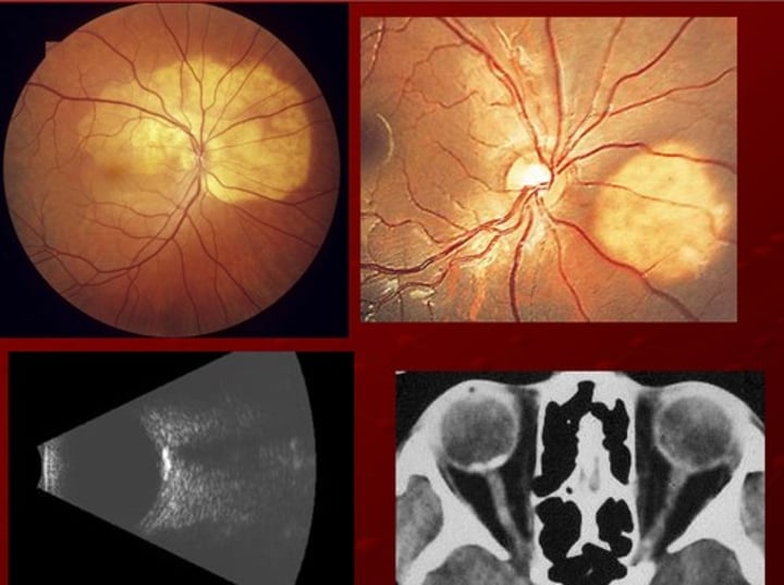 <p>VERY RARE women 20-30s, benign slow growing tumor<br>-tumor of mature bone w/ overlying RPE atrophy<br>-gradual visual impairment<br>Signs: peripapillary/macular region<br>Tx: none</p>