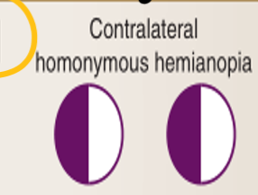 <p>Contralateral homonymous hemianopia</p>