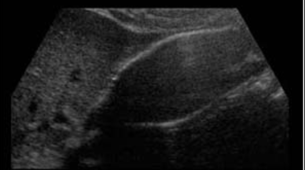 <p>Calcified GB wall; strongly associated with carcinoma </p><p>Echogenic wall with shadowing; complete or partial calcification pattern </p>
